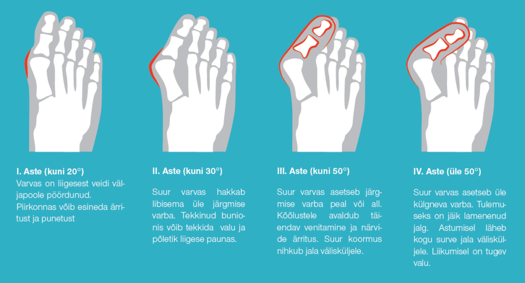 hallux valgus